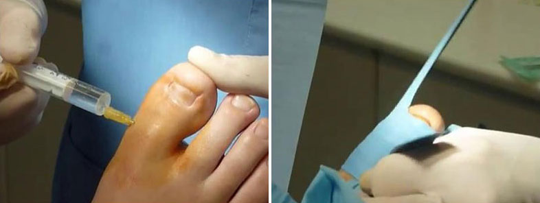 Cirugía Ungueal en Onicocriptosis en clínica de Málaga