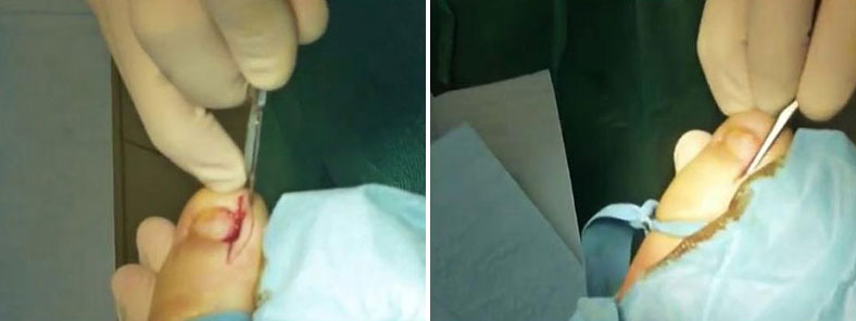 Doble incisión y legrado de matriz