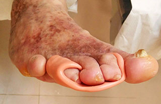 Servicio de Pies diabéticos