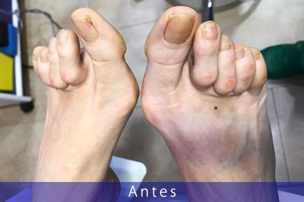 Cirugía del pie en Málaga