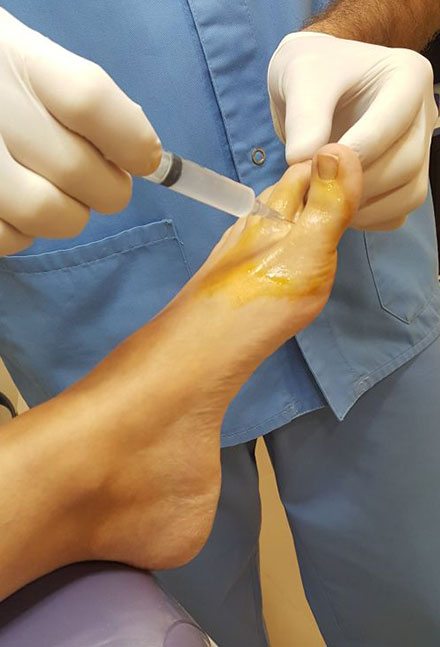 Infiltraciones en Málaga