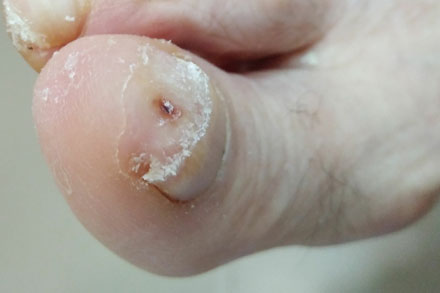 Patologías Dérmicas y Ungueales en Málaga