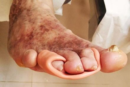 Conocemos todos los problemas del pie diabético