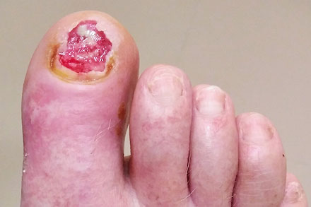 Cuidamos y tratamos el pie diabético en Málaga