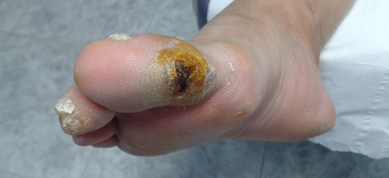 Podólogo en Málaga para tratar eficientemente el pie diabético