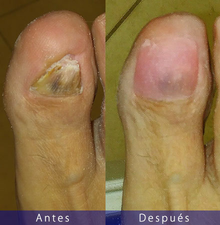 Uña acrílica en clínica podológica