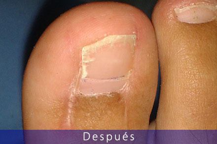 Servicio de cirujía podológica uñas encarnadas