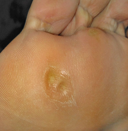 Tratamiento de la verruga plantar en Málaga